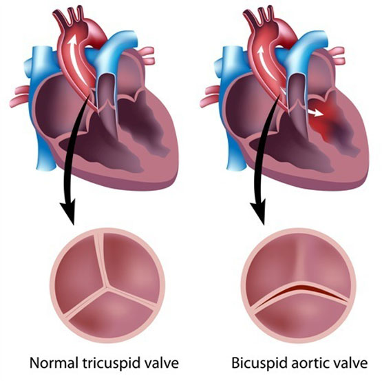 Bicuspid Aortic Valve