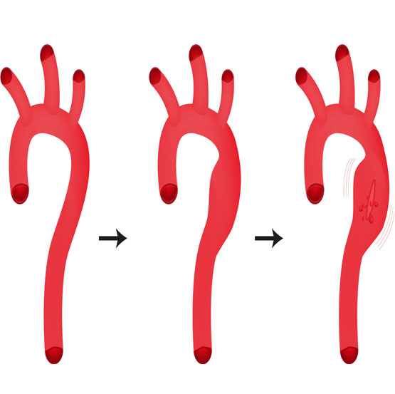 Marfan Syndrome illustration